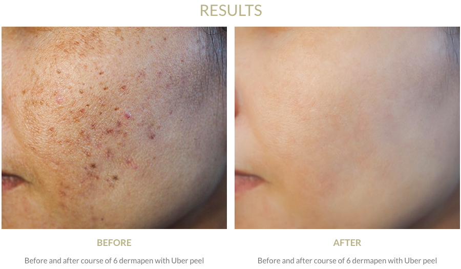 Dr Leah Dermapen Before and After Image